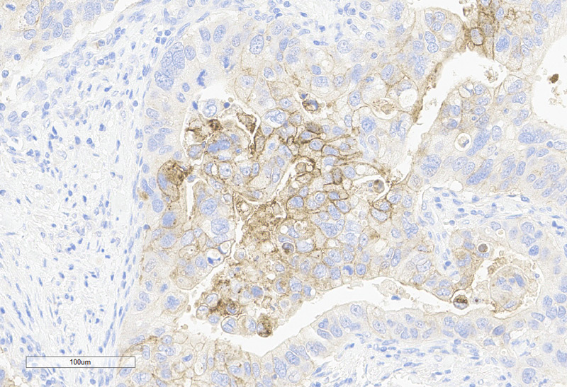 Immunohistochemistry (Formalin/PFA-fixed paraffin-embedded sections) -Recombinant Monoclonal Anti-Claudin-18.2 Antibody, Mouse (3B10)(HCS-S278)Human Colorectal Cancer, 20X